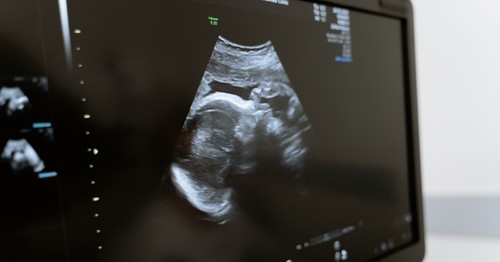  Agree or disagree: A fetus over six weeks should be tax deductible